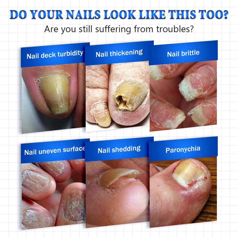 Fungal Treatment, Ingrown Toenails and Strengthening of Fingernails and Toenails